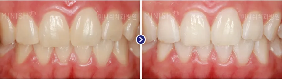 Minish Dental Hospital teeth whitening personalized medical system Seoul