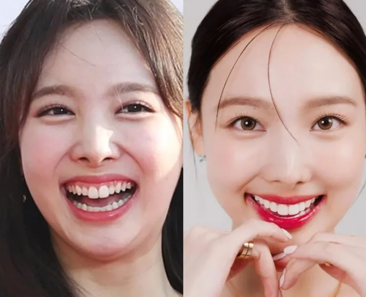 Don't Shave Your Teeth to Pegs: The 0.1mm Miracle of Korean Non-Prep Veneers
