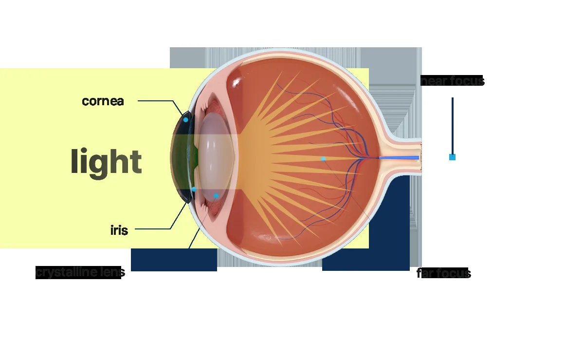 Cataract Surgery in Korea